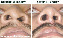 rhinoplasty Nose correction surgery