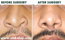 rhinoplasty in India