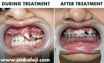 teeth alignment