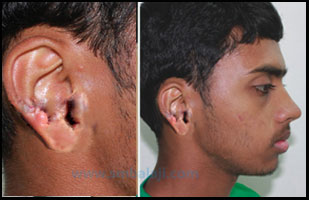 Jaw deformity surgery - Baalji Dental Chennai