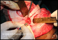 Orbital Hypertelorismduring the Surgery, Dr SM Balaji