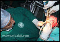 Orbital Hypertelorism during the surgery, Dr SM Balaji