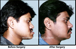 Jaw deformity surgery - Balaji Dental