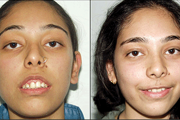 Jaw Deformity Correction