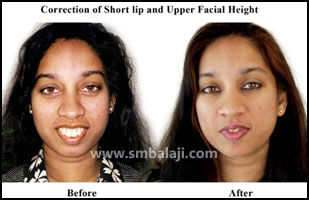 Jaw deformity surgery - Balaji Dental