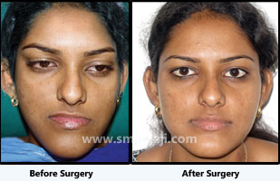 Jaw deformity surgery - Balaji Dental