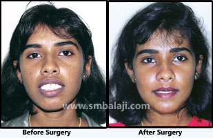 Jaw deformity surgery - Balaji Dental