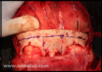 Marking the bone cuts, to remove excess bone