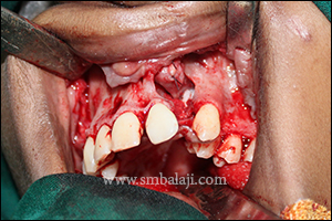 During procedure cleft alveolus was surgically exposed