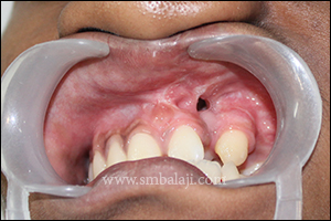 Preoperative view showing cleft alveolus in the unilateral cleft defect in left side