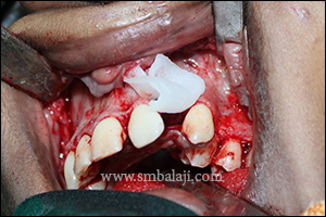 Miracle protein rhBMP-2 placed in the cleft alveolus defect for the cleft closure