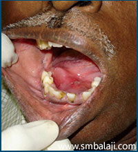 A bulge on the right side of the floor of the mouth indicating the presence of submandibular gland calculus