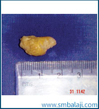 Excised calculus (salivary gland stone)
