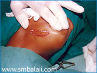 Incision placed for removal of submandibular gland