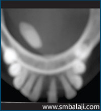 Occlusal radiograph of the same person showing an oblong radiopacity of the calculus in the right side of the mandible