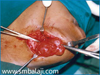 Submandibular gland removed