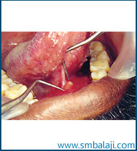 Submandibular salivary gland calculus present at the entrance of the duct