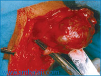 Surgical removal of parotid gland