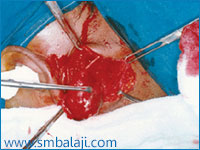 Surgical removal of parotid gland