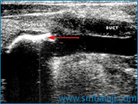 Ultrasound showing the presence of calculus in the salivary gland duct