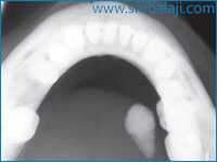 X-ray of the mandible (lower jaw) showing a mass in the floor of the mouth on the right side denoting a submandibular gland stone